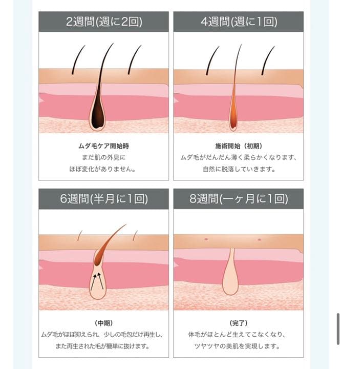Sarlisi 脱毛器 家庭用