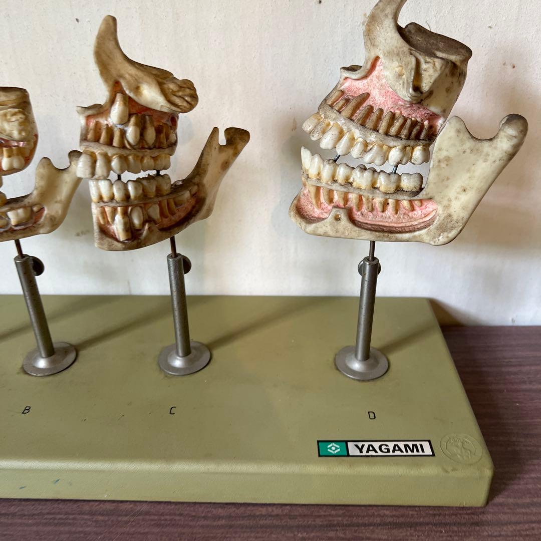 歯のモデル　発育模型